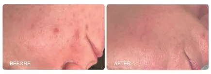 Before / after skin example