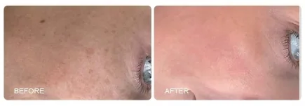 Before / after skin example